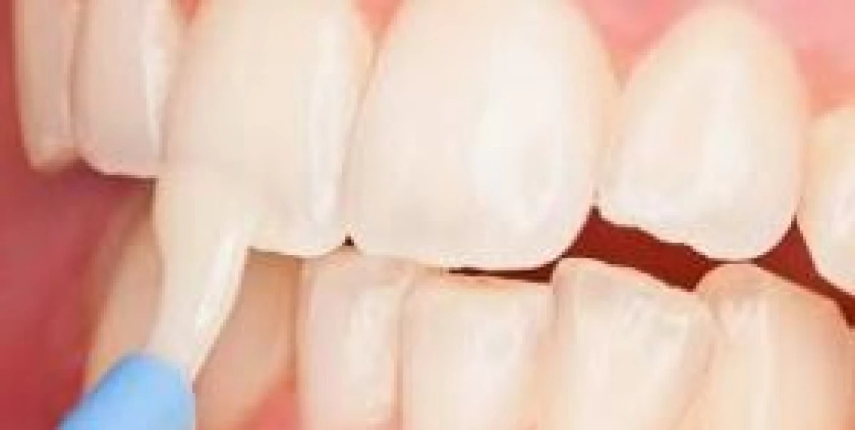 Flor&uuml;r&uuml;n dozu &ouml;nemli, fazlası zararlı!